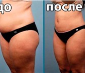 Фото в Красота и здоровье Похудение, диеты Главное показание к проведению липокоррекции в Ставрополе 2 000